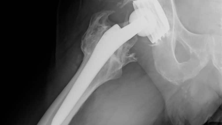 Comment soulager la douleur au psoas après une prothèse de hanche